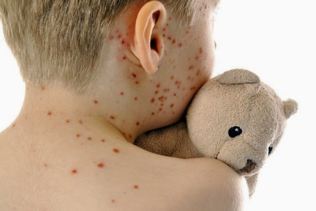 Il morbillo nei bambini: Cause,Cure e rimedi.