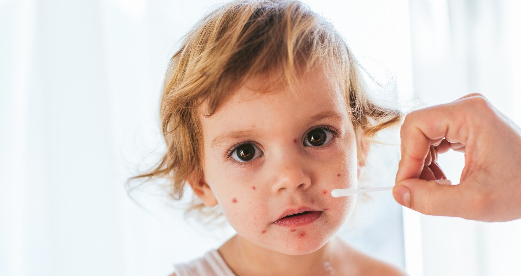 Varicella nei bambini e nei neonati: cause,sintomi,e rimedi.